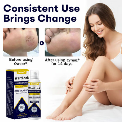 🎅 𝘾𝙝𝙧𝙞𝙨𝙩𝙢𝙖𝙨 𝙎𝙖𝙡𝙚 | Cvreoz® WartLock CRYO RECOVERY SPRAY
