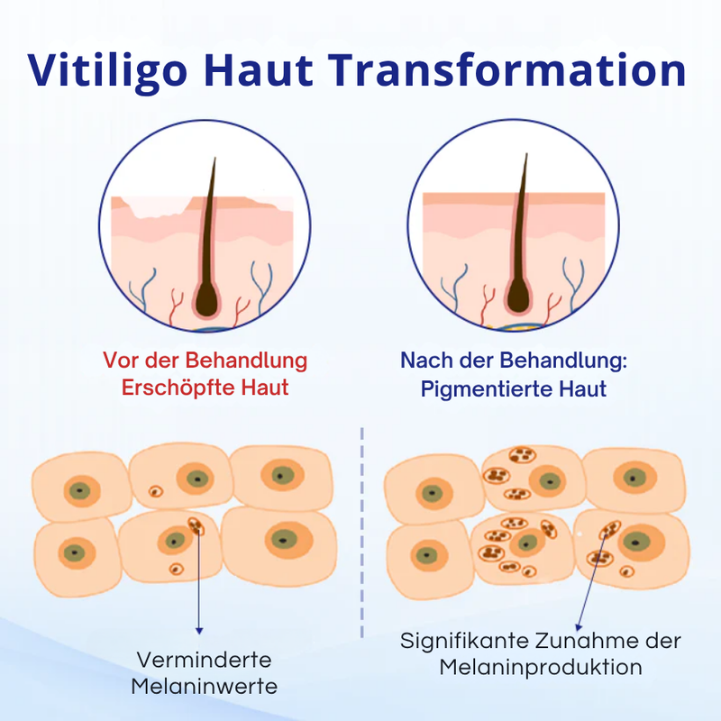 Kubozn® Spray gegen Vitiligo — Dermatologisch getestet, pflanzlich & steroidfrei