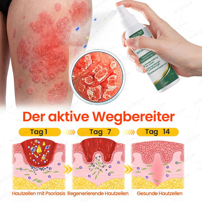 KUBOZN® Psoriasis Tag & Nacht System – 100% steroidfrei gegen Schuppen & Plaque (offer)