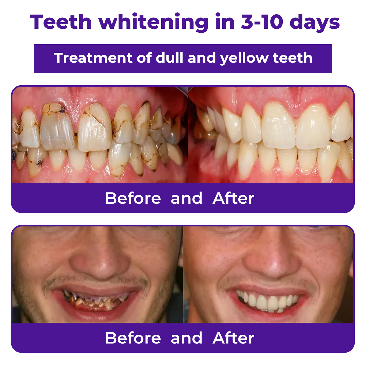 🦷Cvreoz® Dental Repair Mineral Powder >> 🔥Buy 1 Get 1 Free🔥