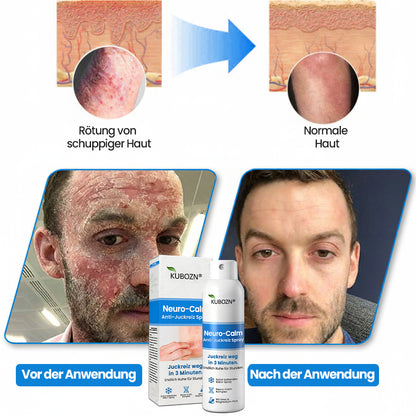 ✅KUBOZN® Magnesium Kräuter-Psoriasis Spray – TÜV Geprüft (Lindert Psoriasis & Ekzeme, verbessert bakterielle Hautinfektionen im Intimbereich, unterstützt bei Akne & Warzen) (Copy)