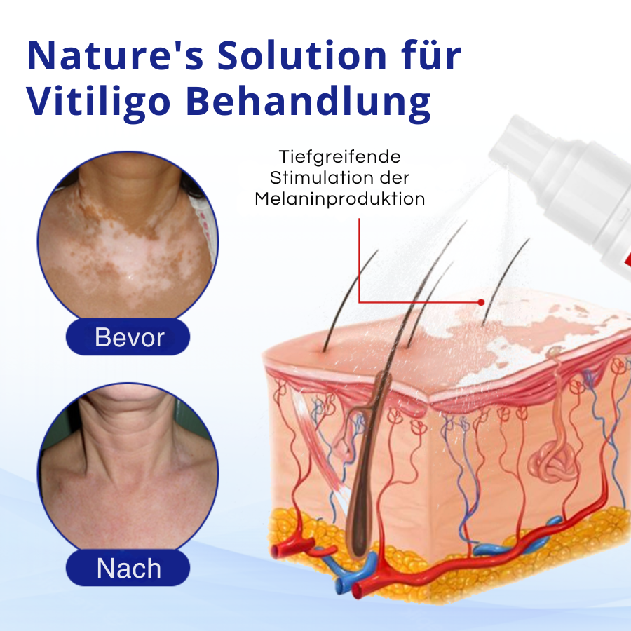 Kubozn® Spray gegen Vitiligo — Dermatologisch getestet, pflanzlich & steroidfrei