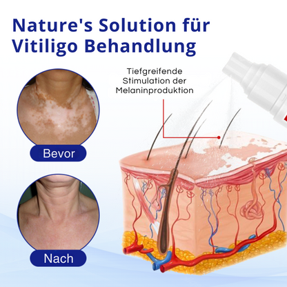 Kubozn® Spray gegen Vitiligo — Dermatologisch getestet, pflanzlich & steroidfrei