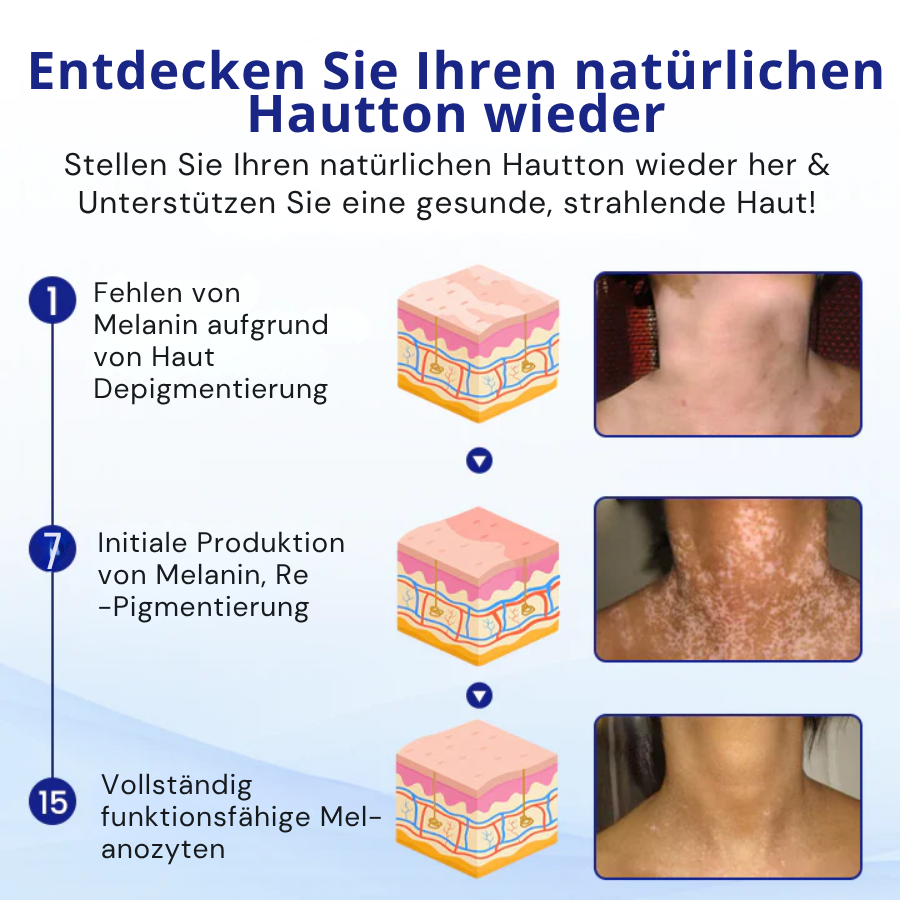 Kubozn® Spray gegen Vitiligo — Dermatologisch getestet, pflanzlich & steroidfrei