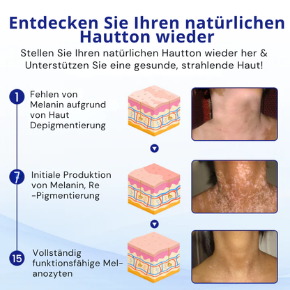 Kubozn® Spray gegen Vitiligo — Dermatologisch getestet, pflanzlich & steroidfrei