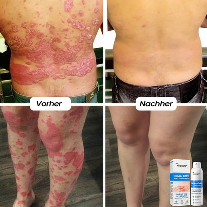 ✅KUBOZN® Magnesium Kräuter-Psoriasis Spray – TÜV Geprüft (Lindert Psoriasis & Ekzeme, verbessert bakterielle Hautinfektionen im Intimbereich, unterstützt bei Akne & Warzen) (Copy)