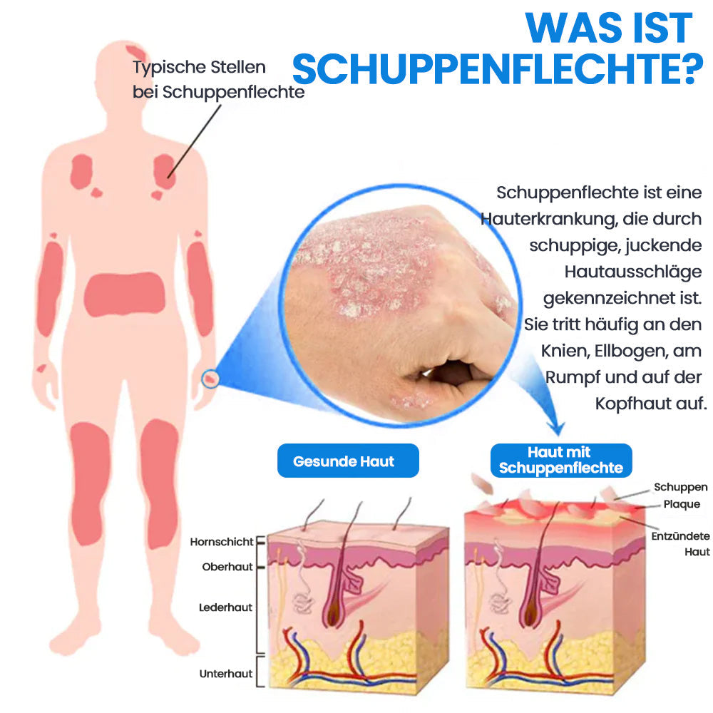 ✅KUBOZN® Magnesium Kräuter-Psoriasis Spray – TÜV Geprüft (Lindert Psoriasis & Ekzeme, verbessert bakterielle Hautinfektionen im Intimbereich, unterstützt bei Akne & Warzen) (Copy)